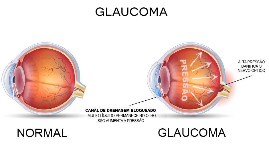 Glaucoma