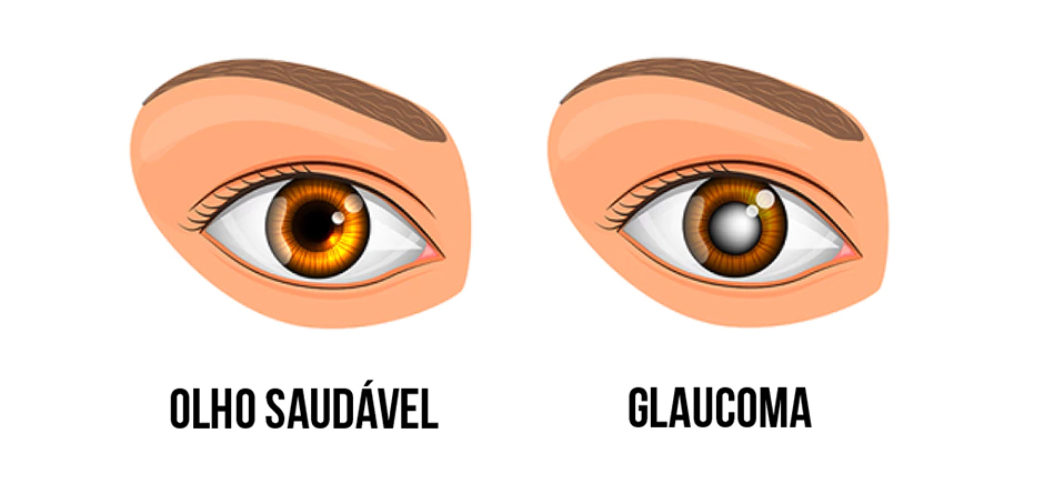 Glaucoma